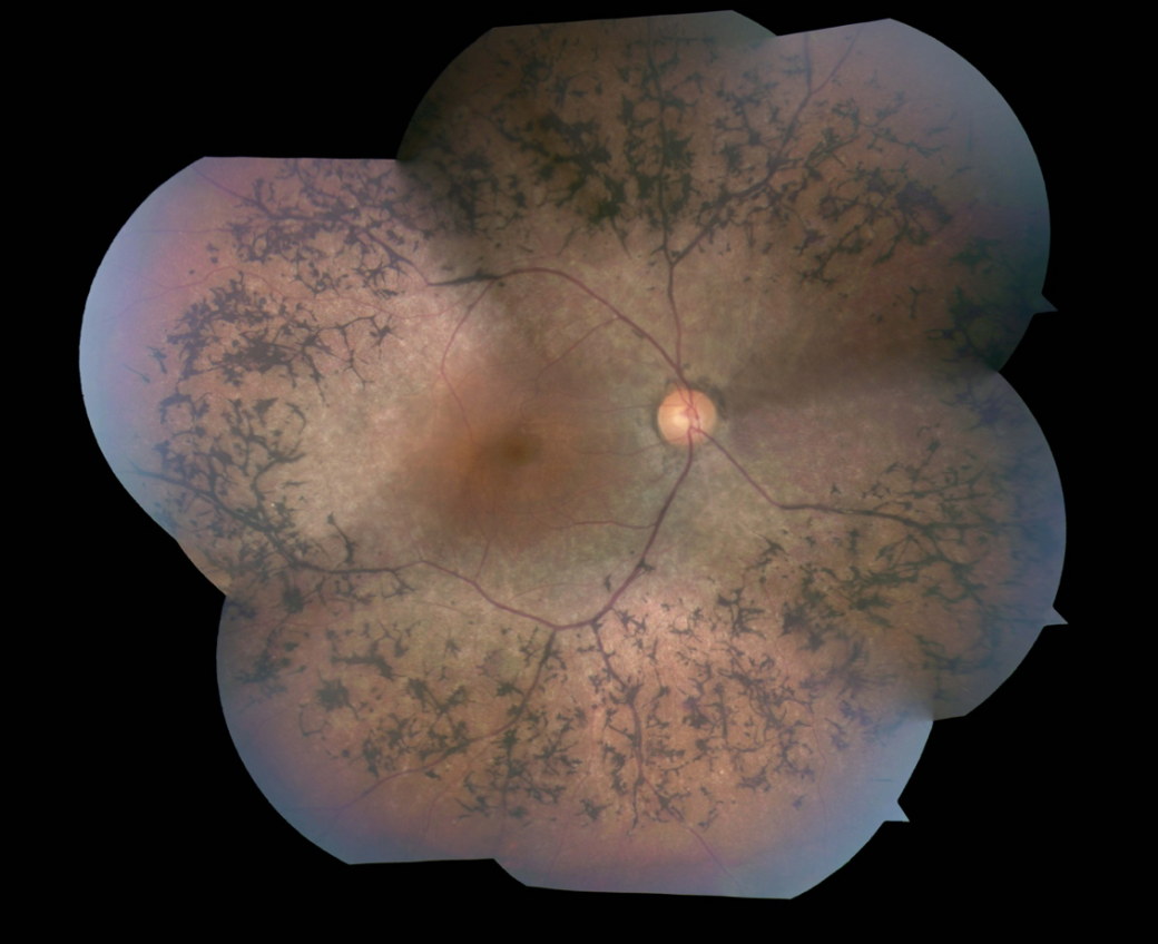 Retinitis Pigmentosa May Be Treated By Reprogramming Sugar Metabolism ...