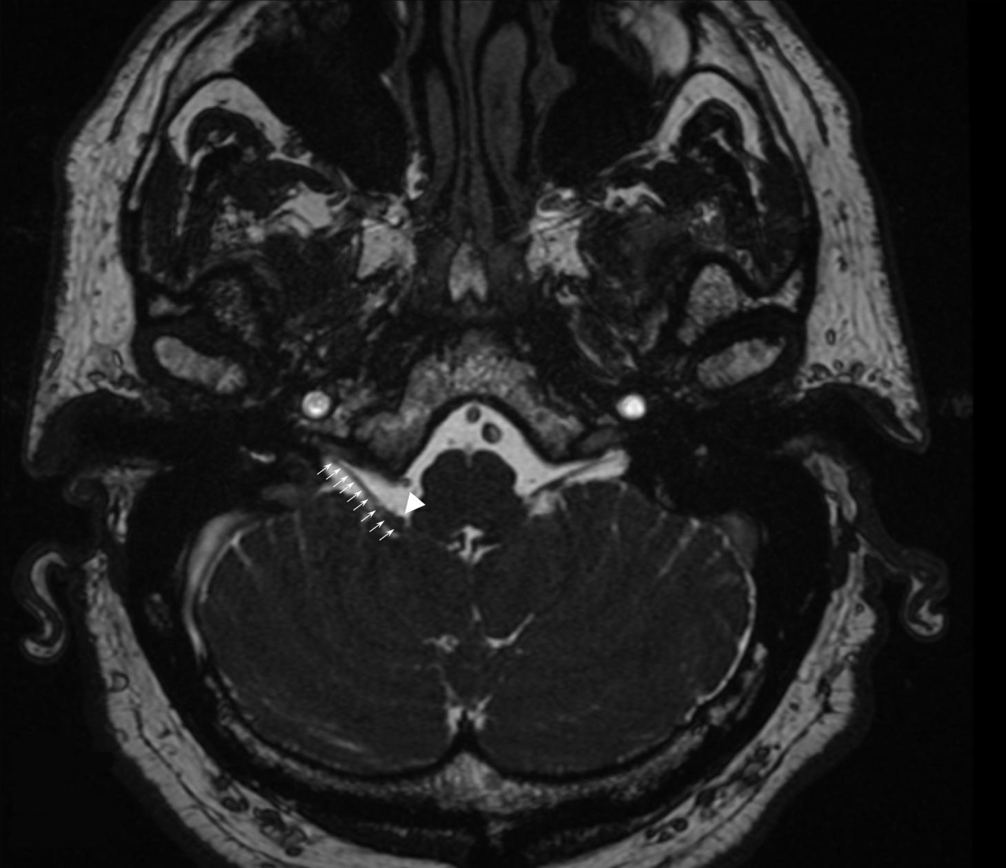 medical scan of the brain showing where artery compresses nerve